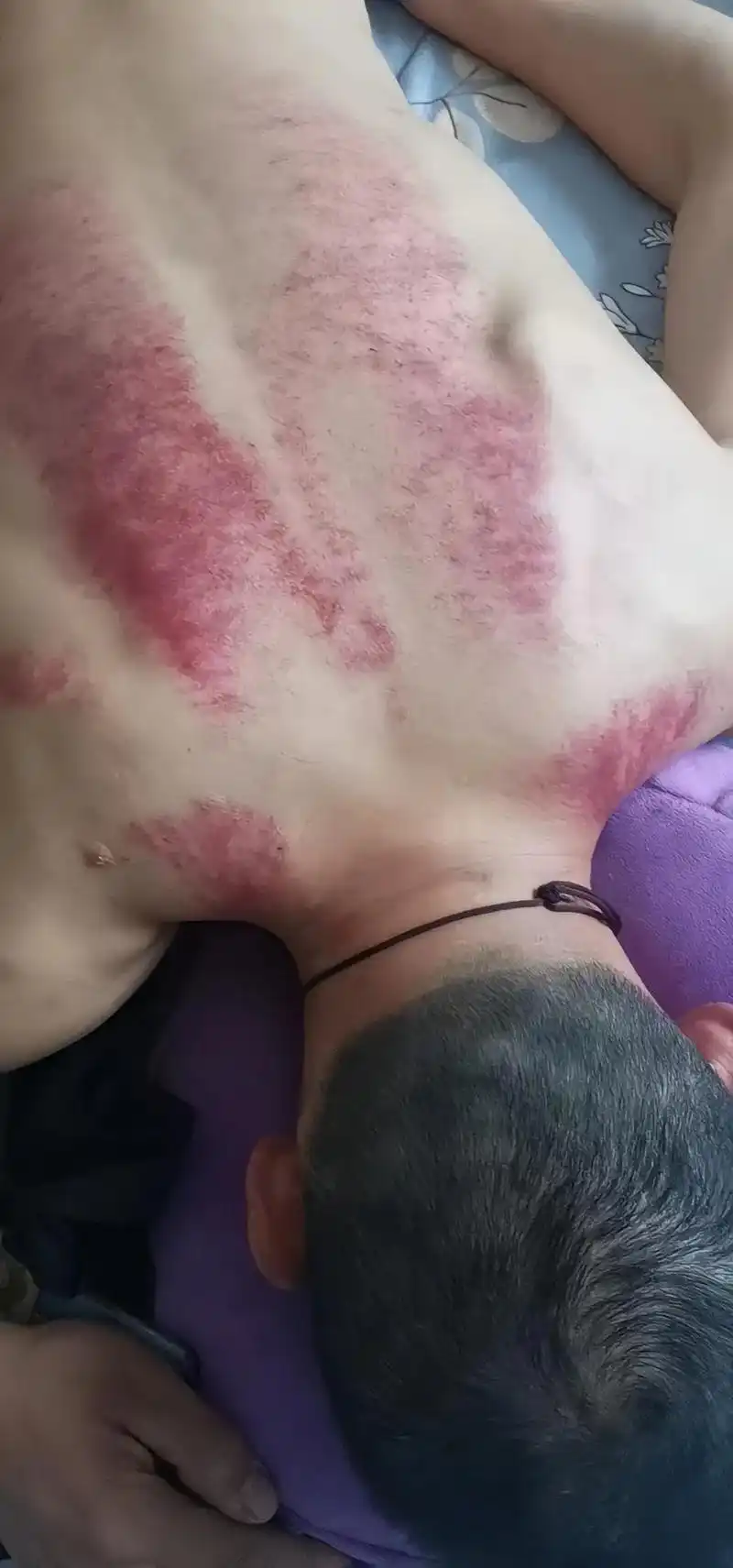 96做身体出痧颜色分六种: 1.黑痧:寒; 2.紫痧:又毒又 - 抖音