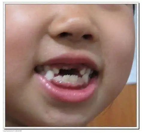 老太太牙齿掉了的图片老太婆牙齿掉光图片2022已更新今日推荐