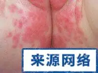 宝宝红屁股的三大原因