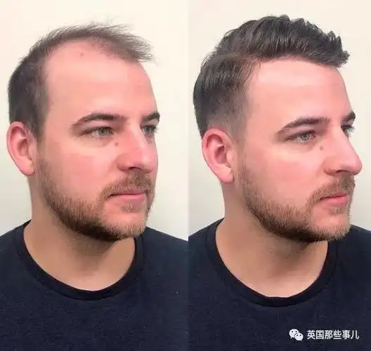在网上一搜,可以搜到好多对比图…越来越多的秃顶男士都开始尝试.