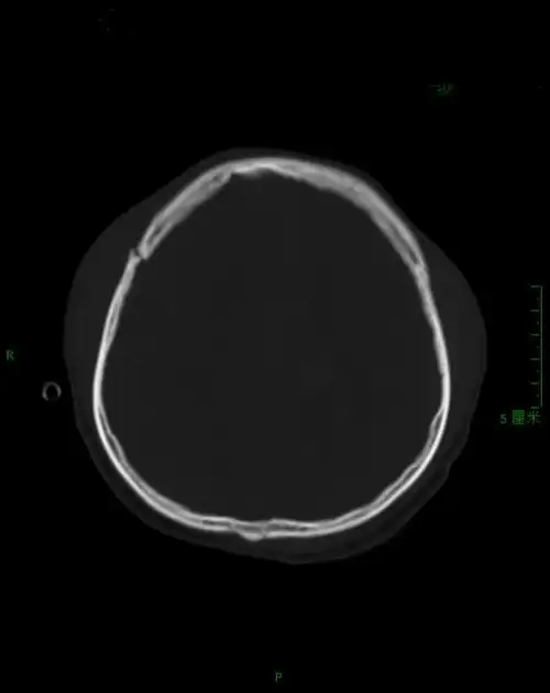 右侧额骨骨折