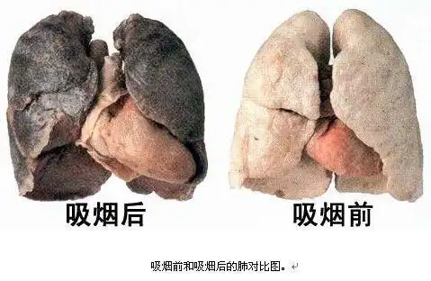 吸烟者的肺部图片,看后让更加了解吸烟的危害! - fjcheng189的日志 -