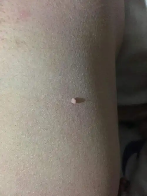 医生提醒女性身上一旦长出这种疙瘩速查hpv警惕宫颈癌