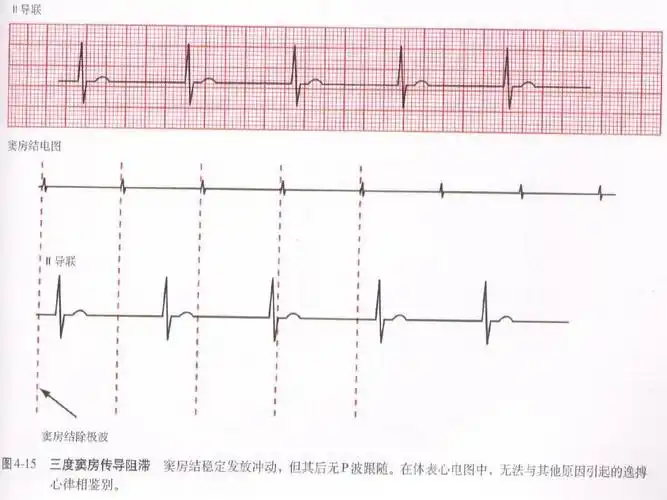 窦房传导阻滞课件ppt