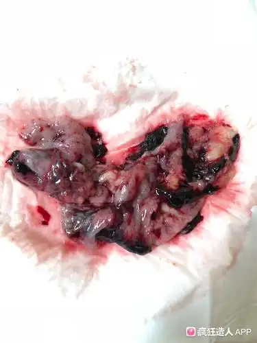 (有图 慎入)塞药后肚子疼了半小时 这个 是孕囊排出来了吗