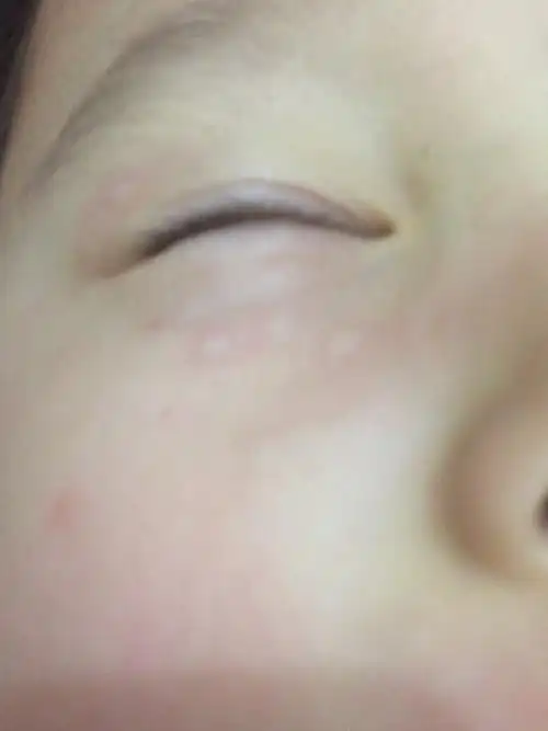 孩子眼皮下面还有面部及后腰部位突然张了白色大小形状不一的扁疙瘩