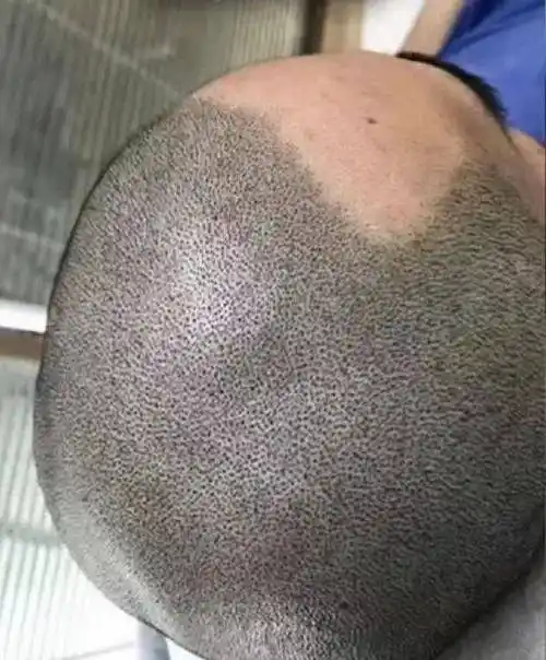 在头皮上"纹"头发,成了秃头星人的救命稻草_学长_毛囊_假发