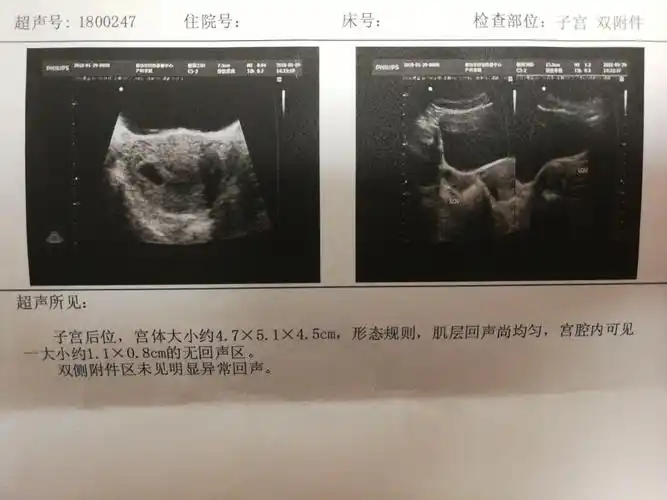 流程!怀孕40天孕囊大小标准值"注意事项"-第2张图片-思度网