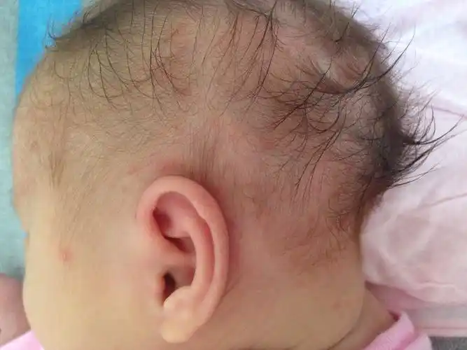 这夏天怎么过啊,闺女头上长了好多痱子