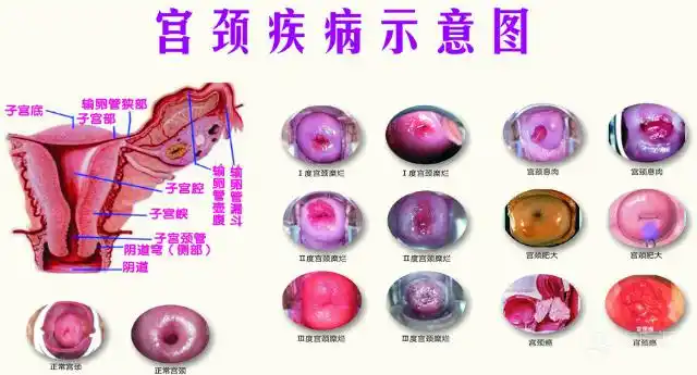 师娟子谈宫颈疾病与不孕