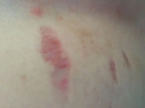 我的右胸乳沟旁一处皮肤凹进去了还有明显的红血丝,这是什么症状?