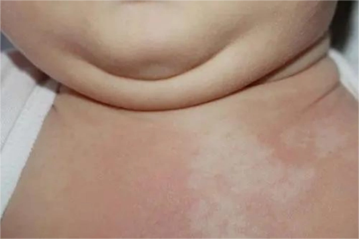 数月或更长时间后可自行消退.白色糠疹新生儿花斑癣图皮