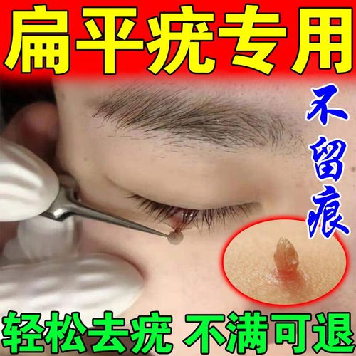 扁平疣专i药克疣膏去疣灵面部脖子小肉粒丝状疣跖疣疣瘊净疣膏 单盒