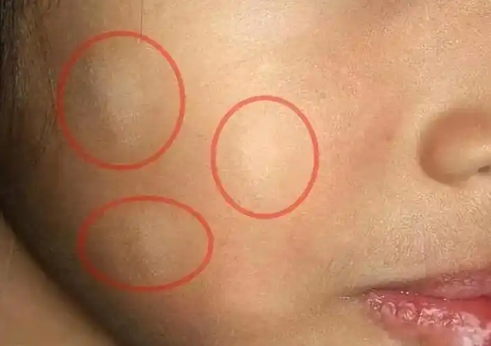 皮肤上长白斑,白点是啥病?怎么回事?3大诱因你知道吗?