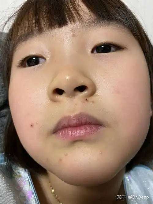 面部传染性软疣不留痕迹 - 知乎