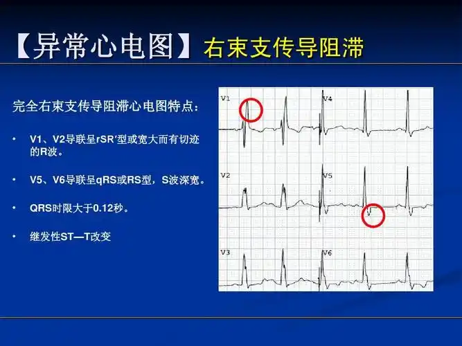认证 ppt模板 心电图幻灯片详解ppt 【异常心电图】右束支传导阻滞