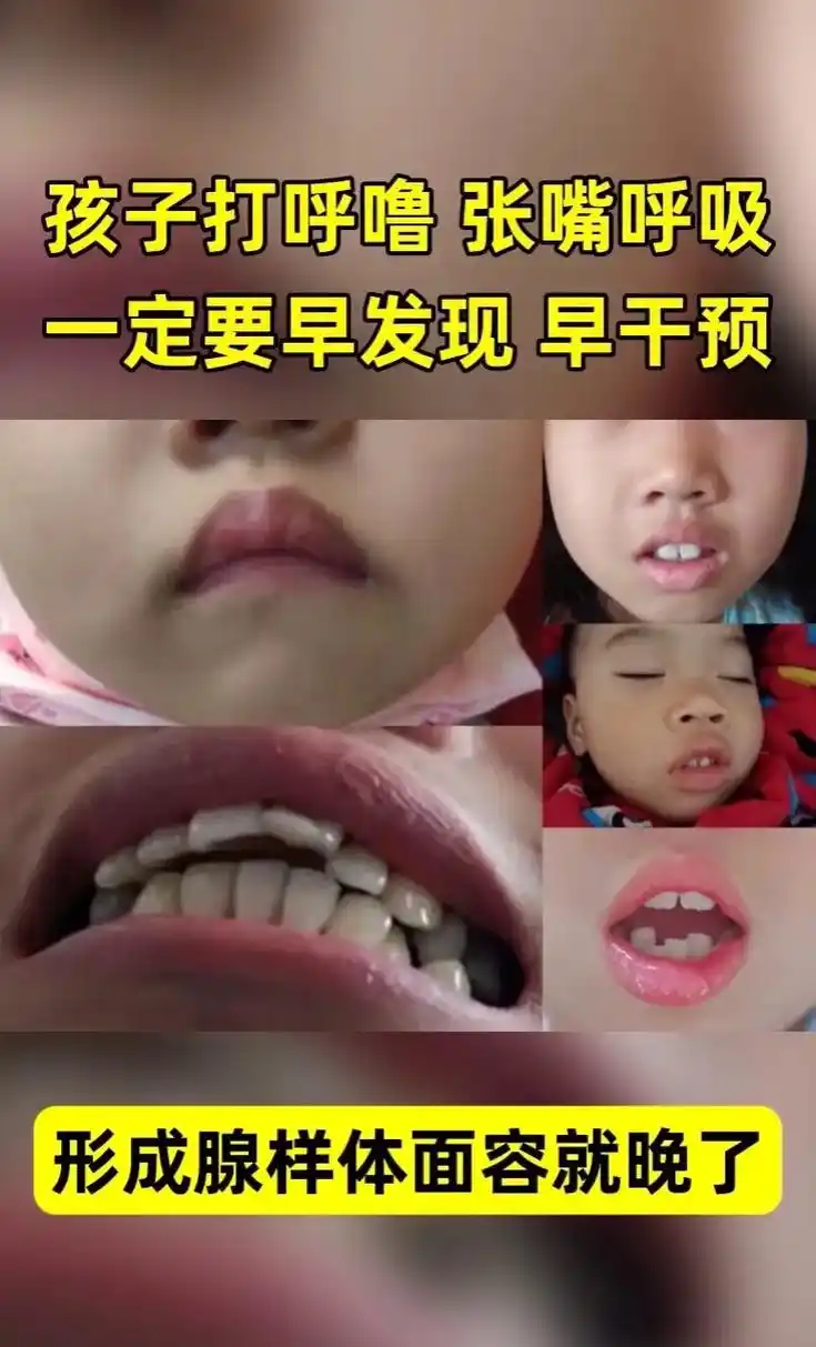 孩子腺样体肥大,可能是吃出来的! 少吃无害,多吃反而生内热. - 抖音