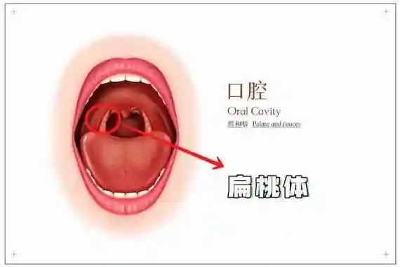 腺样体肥大与扁桃体有什么联系?腺样体切除手术需要切除扁桃体吗