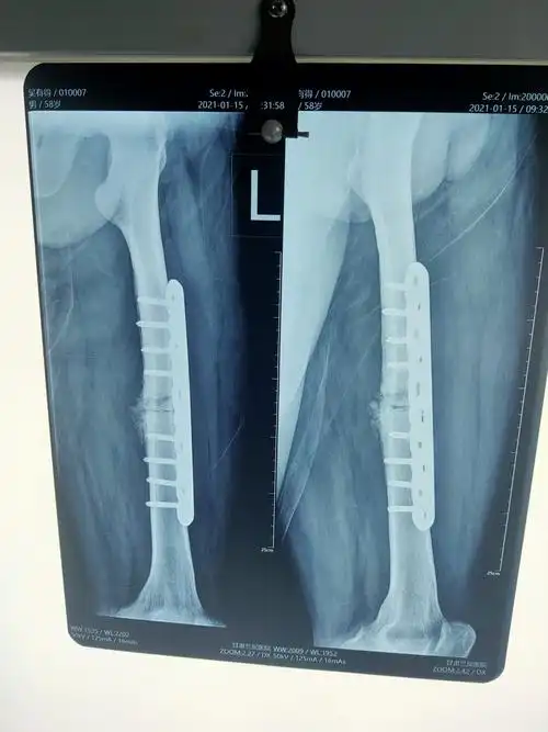 术后三月复诊,拍片显骨折断端愈合良好!