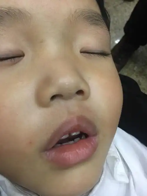 鼻涕和鼻屎,拍了鼻咽镜和侧位片,孩子的上嘴唇从出生开始就有点上翘