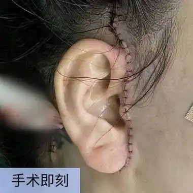 分享拉皮手术后,手术即刻,10天,1个月,4个月这四个阶段切口的恢复情况