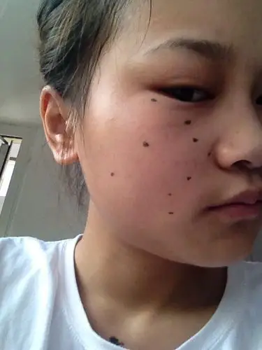 我想去痣,麻烦懂面相的人帮我看看,脸上这些痣都能去掉吗?