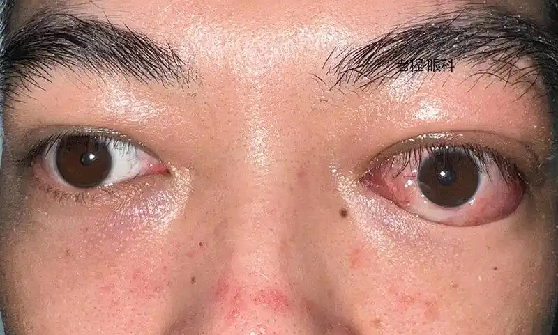眼球突出和眼睑退缩.jpg