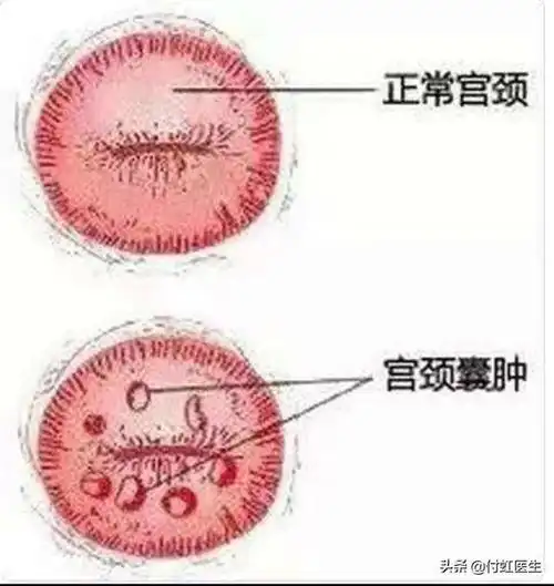 宫颈糜烂,宫颈纳囊,宫颈息肉,宫颈湿疣,hpv,看这一篇够了-健康界