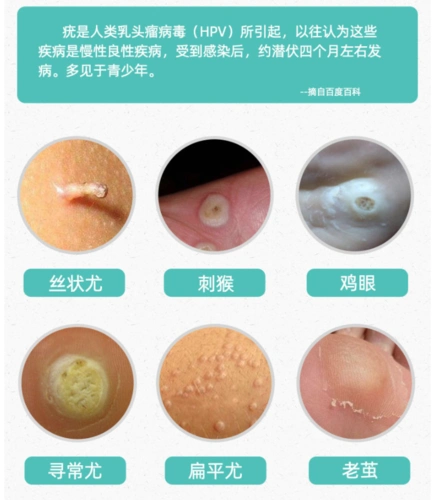 跖疣是什么病脚上长跖疣怎么办
