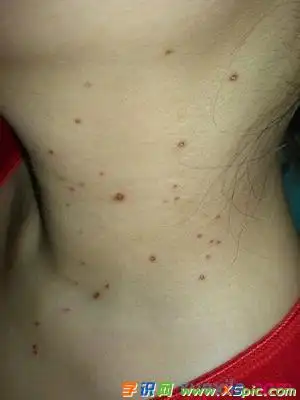 丝状疣 症状危害