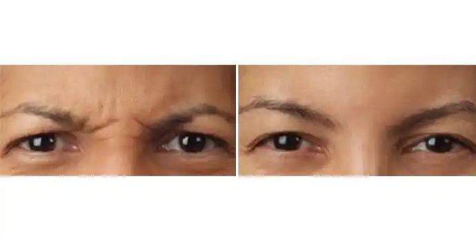 好颜网肉毒素去鼻背纹