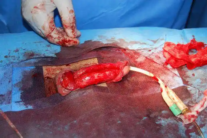 阴茎弯曲矫正术