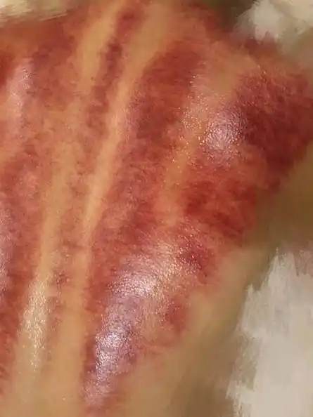 背部刮痧后如图,身体情况如何?