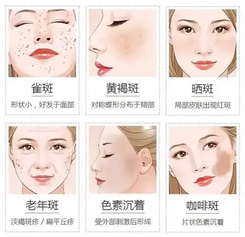 【超皮秒祛斑】为什么秋季色斑会加深?