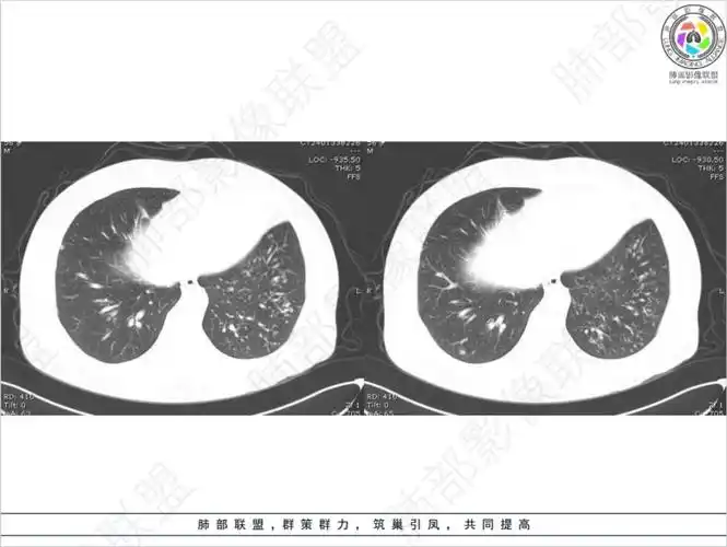 病灶多灶性,多态性,这个病例如何确诊肺结核?