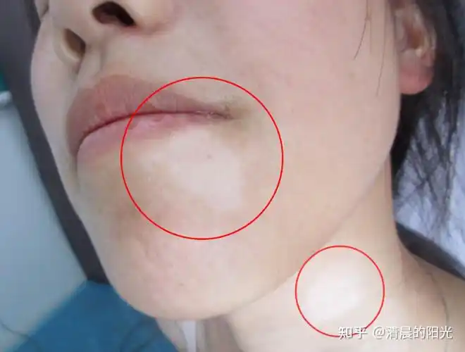 我想问吸烟对白癜风有影响吗?