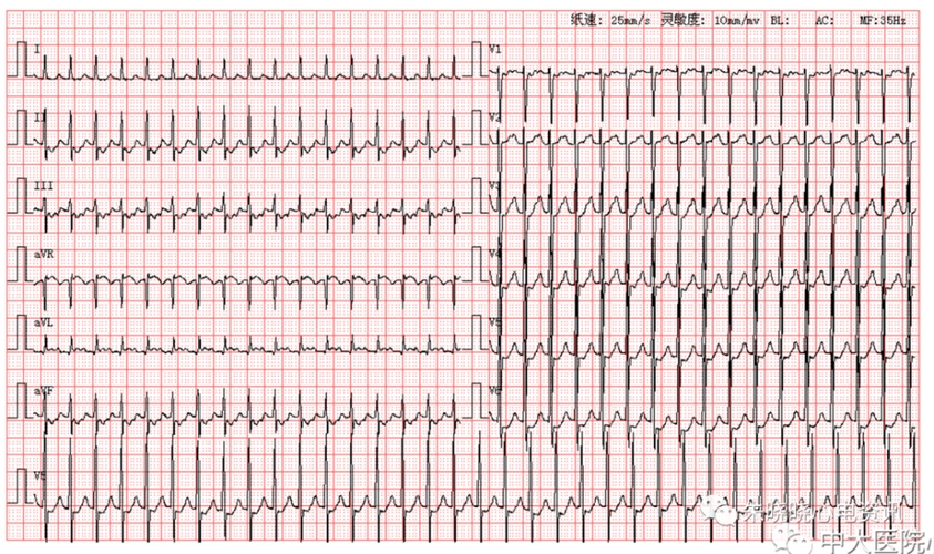 每日读图|第1646期 室早 左前分支传导阻滞_腾讯新闻