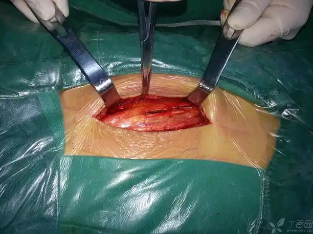 同切口,更微创取出胸腰段gss钉棒系统