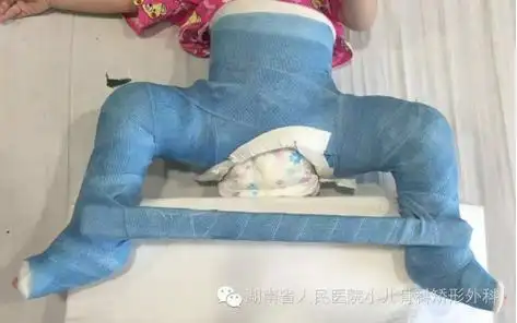 先天性髋关节脱位为什么越早治疗越好?