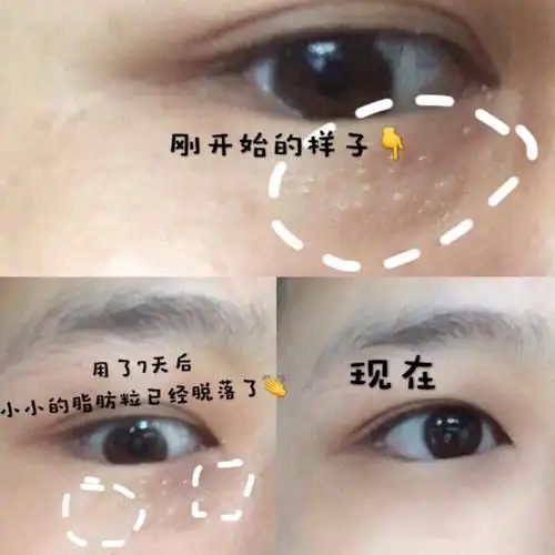 眼角脂肪粒怎么去除最有效果眼睛周边长白点怎么办脂肪粒是去脂肪粒