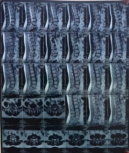 问题:腰椎间盘突出症咨询