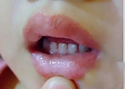 鹅口疮的治疗方法有什么?