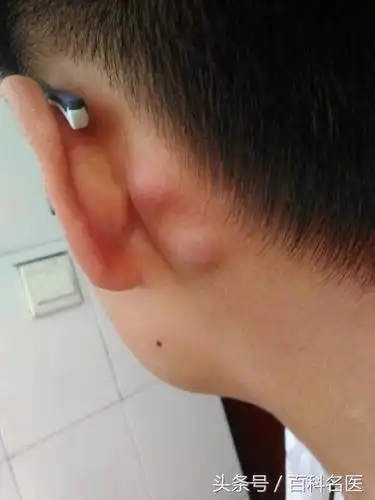 皮下脂肪瘤 脂肪瘤与粉瘤症状比较相似,但是脂肪瘤的皮肤略有不同.