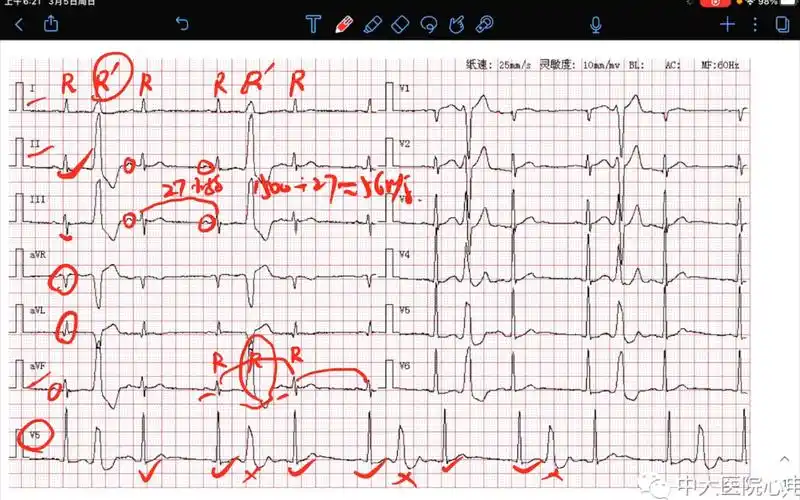窦性心动过缓,间位室早三联律,逆钟向转位,部分肢体导联低电压