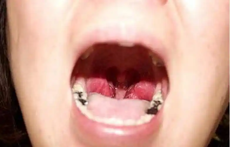 扁桃体肥大如何治疗?