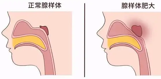 儿童腺样体肥大常见原因为炎症如急慢性鼻炎,扁桃体炎,流行性感冒等