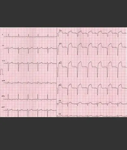 心肌梗死心电图