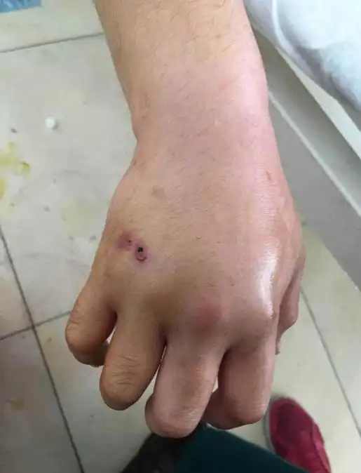 小毒蛇咬伤伤口图下面毒蛇网小编就来分享一种小蛇咬伤伤口图片,部分