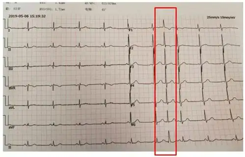 室性早搏的心电图特点
