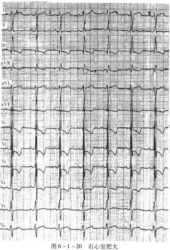 左,右心室肥厚检查 - 问答库